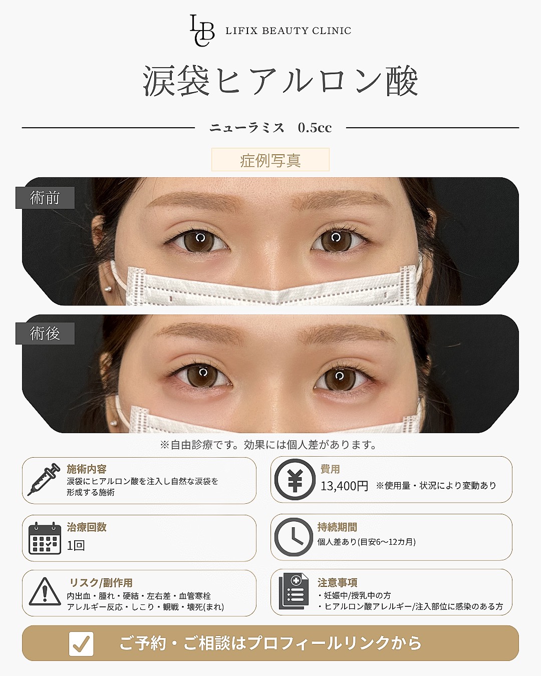 涙袋ヒアルロン酸注入