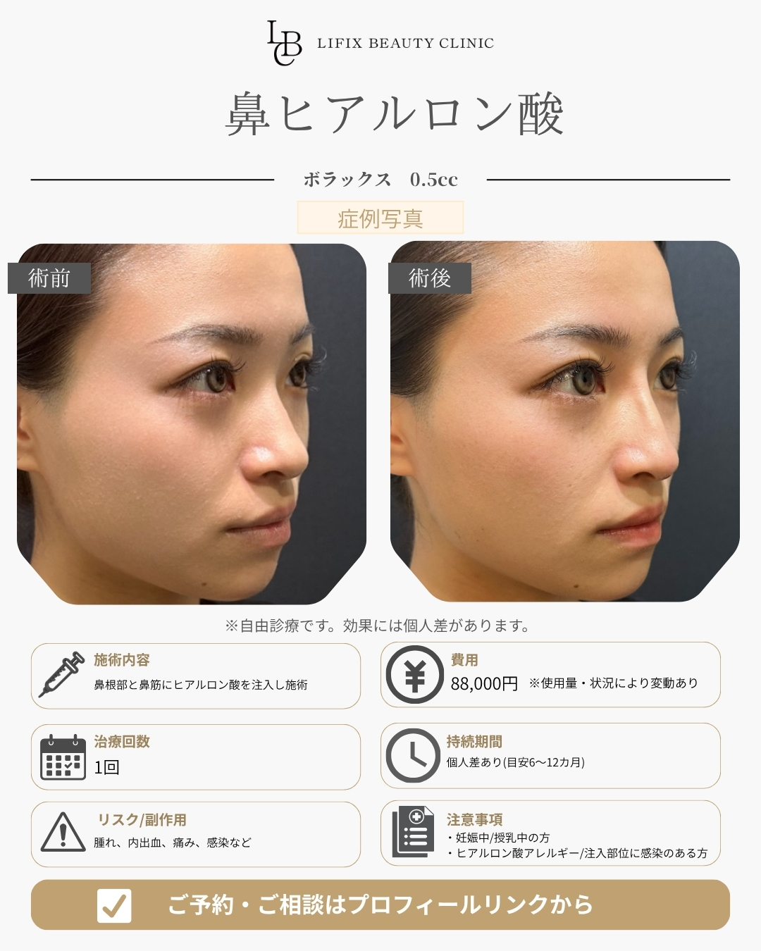 鼻ヒアルロン酸注入