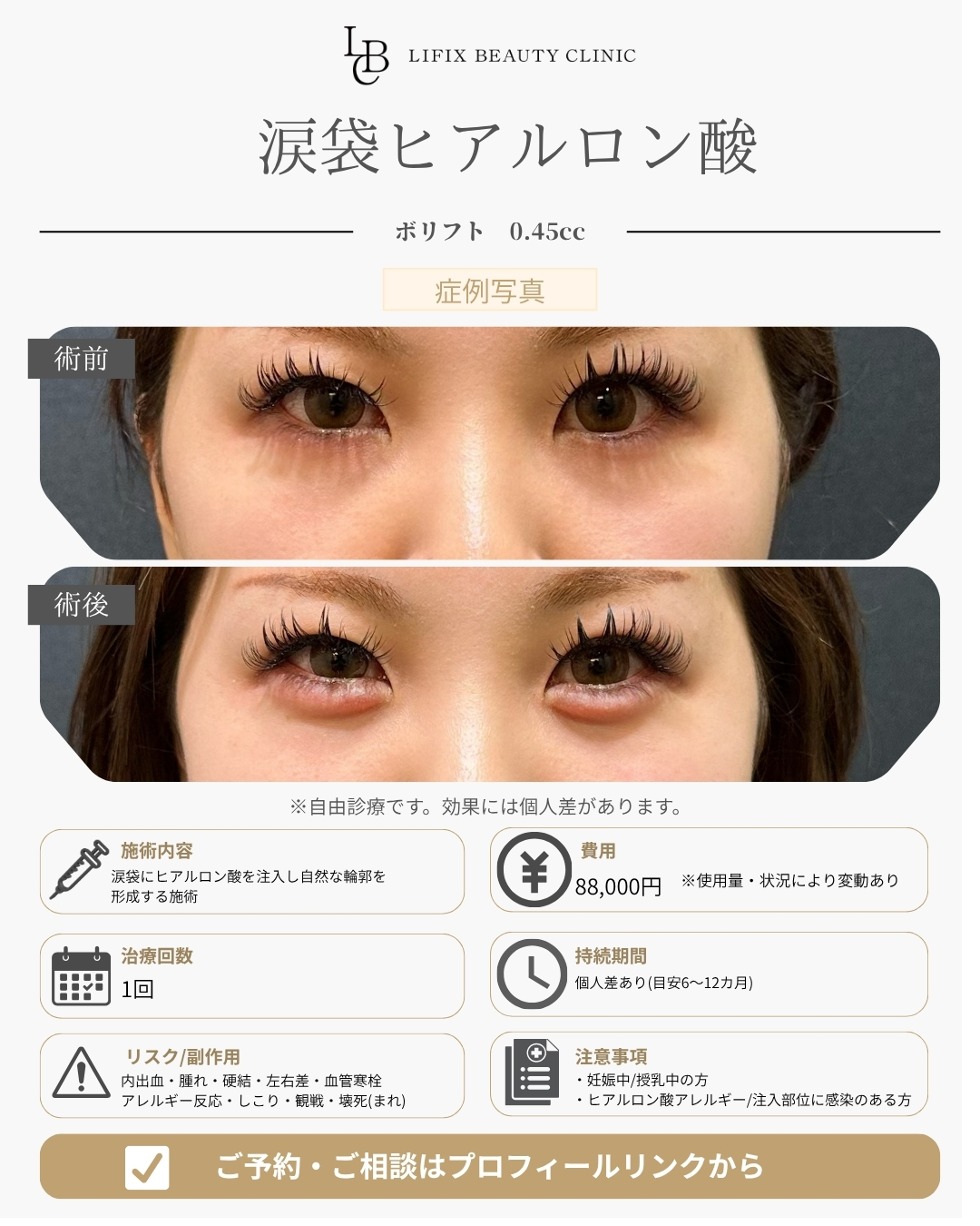 涙袋ヒアルロン酸注入