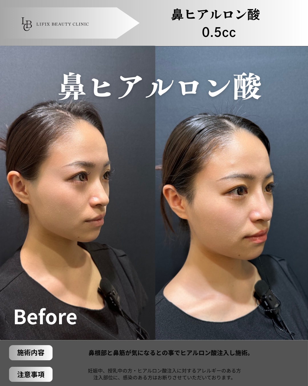 涙袋ヒアルロン酸