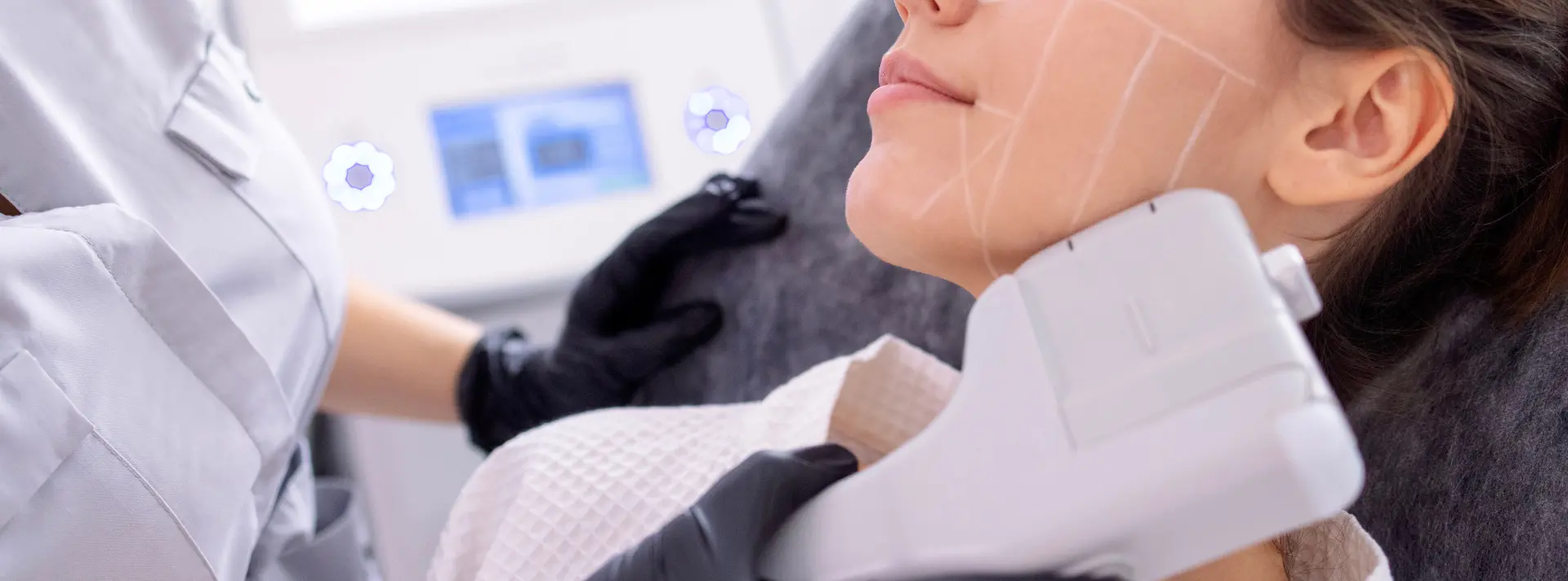 ハイフシャワー（ウルトラフォーマーMPT使用）